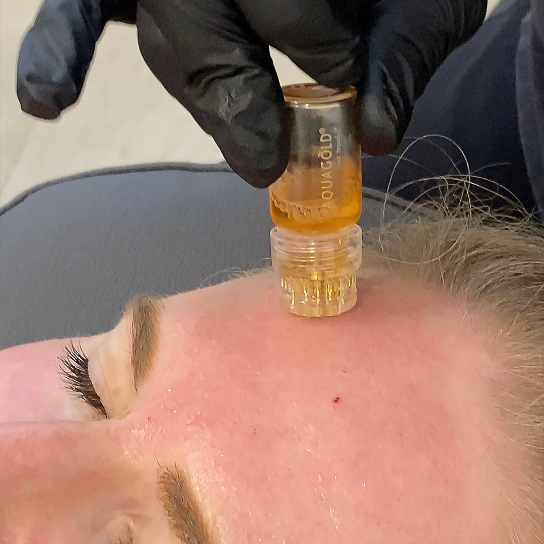 a patient receiving an aquagold micro-challening treatment. the vial is being held to the patients face.