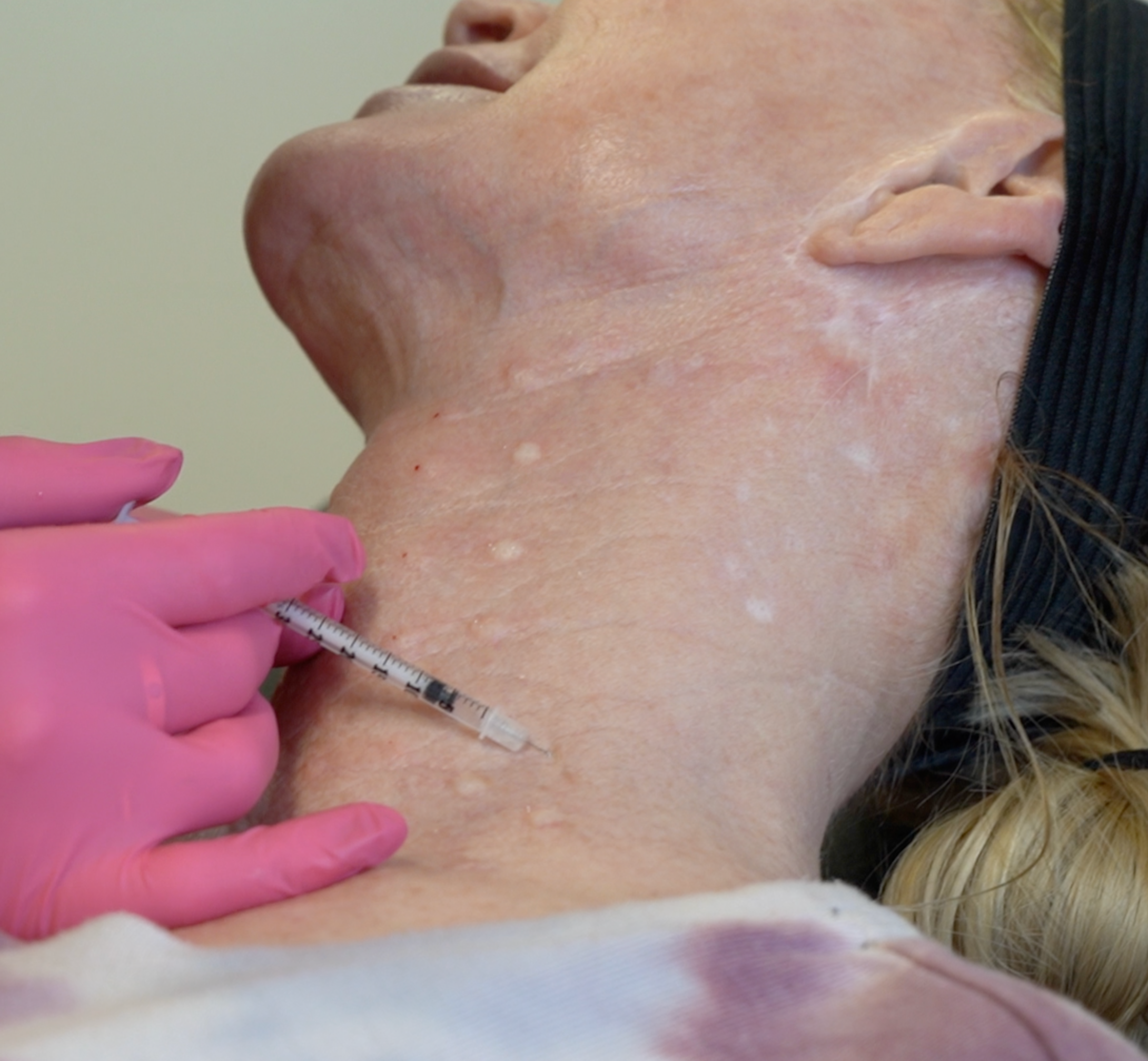 woman with pink gloves injecting a patients neck with micro toxin. patients neck has raised bumps from where the toxin was placed