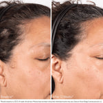 Before and after using BioStim Scalp Serum showing improved hair density at the temple after 12 weeks