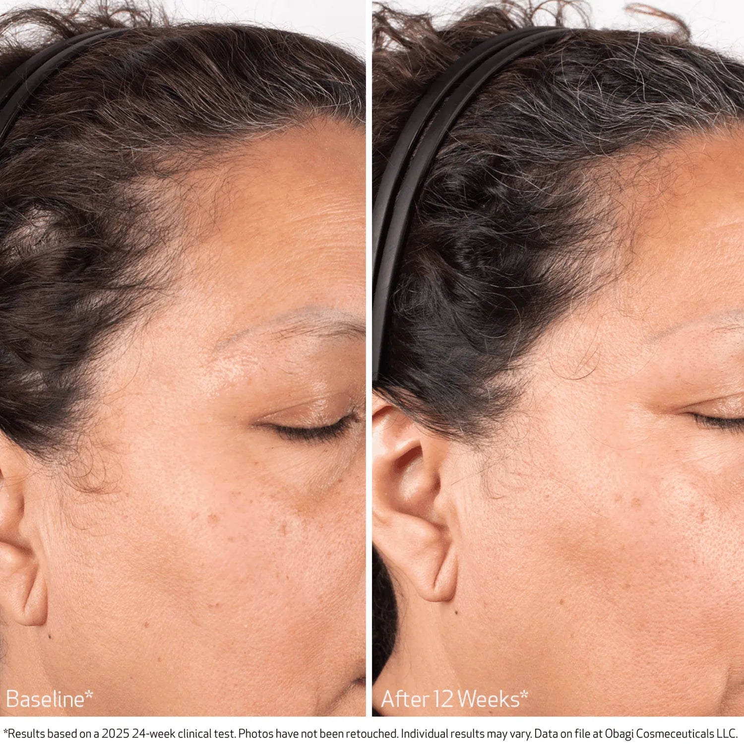 Before and after using BioStim Scalp Serum showing improved hair density at the temple after 12 weeks