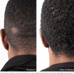 Before and after using BioStim Scalp Serum showing increased hair growth at the back of the scalp after 12 weeks
