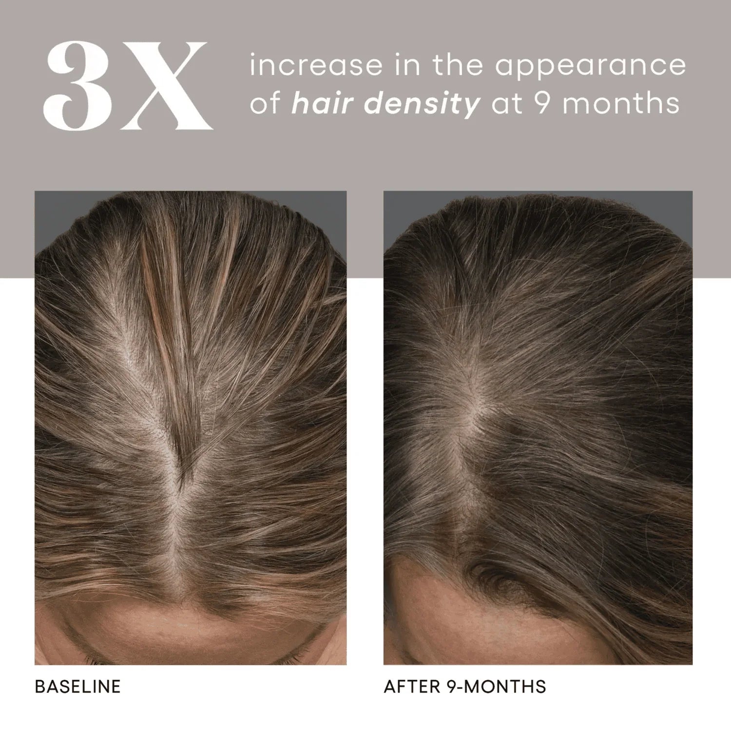 Before and after using plated hair serum showing increased hair density at the part after 9 months