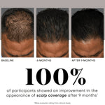 Before and after using plated hair serum showing improved scalp coverage over 9 months