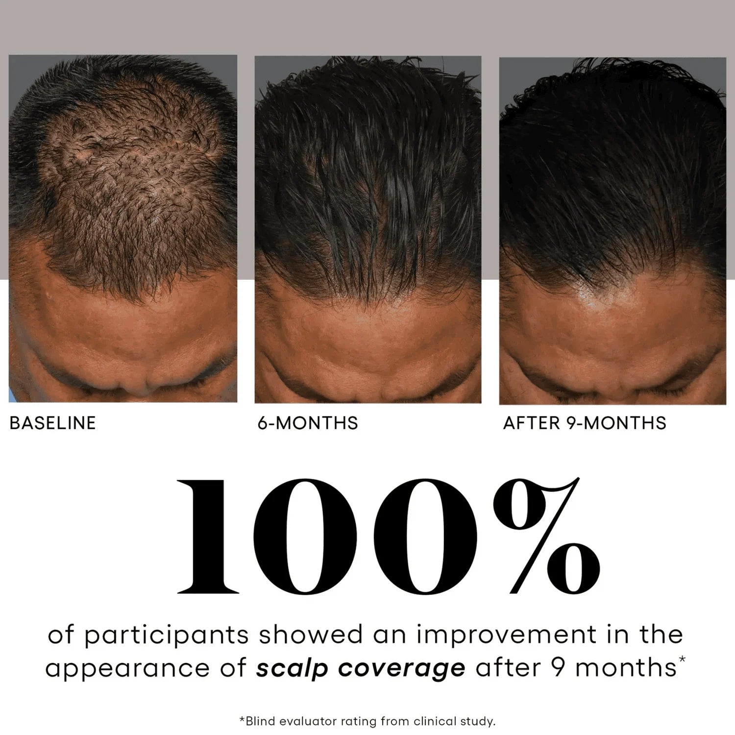 Before and after using plated hair serum showing improved scalp coverage over 9 months